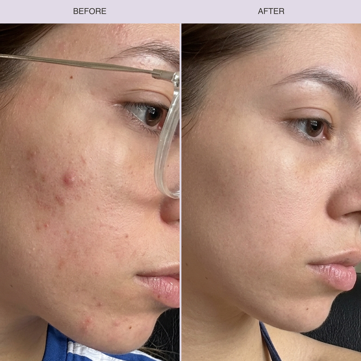 LED Light Therapy Face Mask