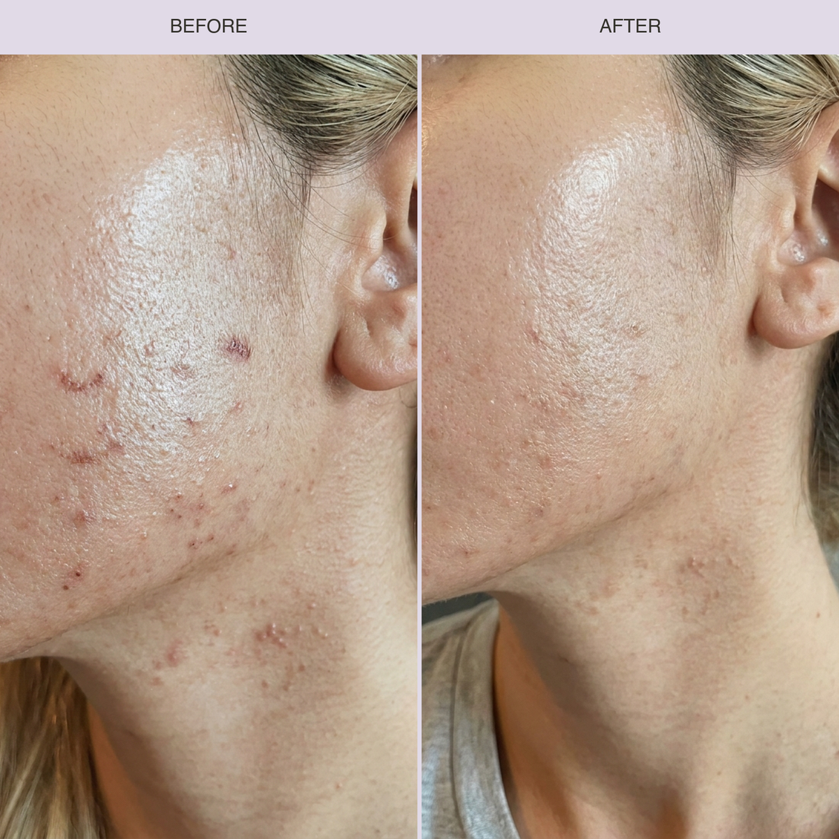 LED Light Therapy Face Mask